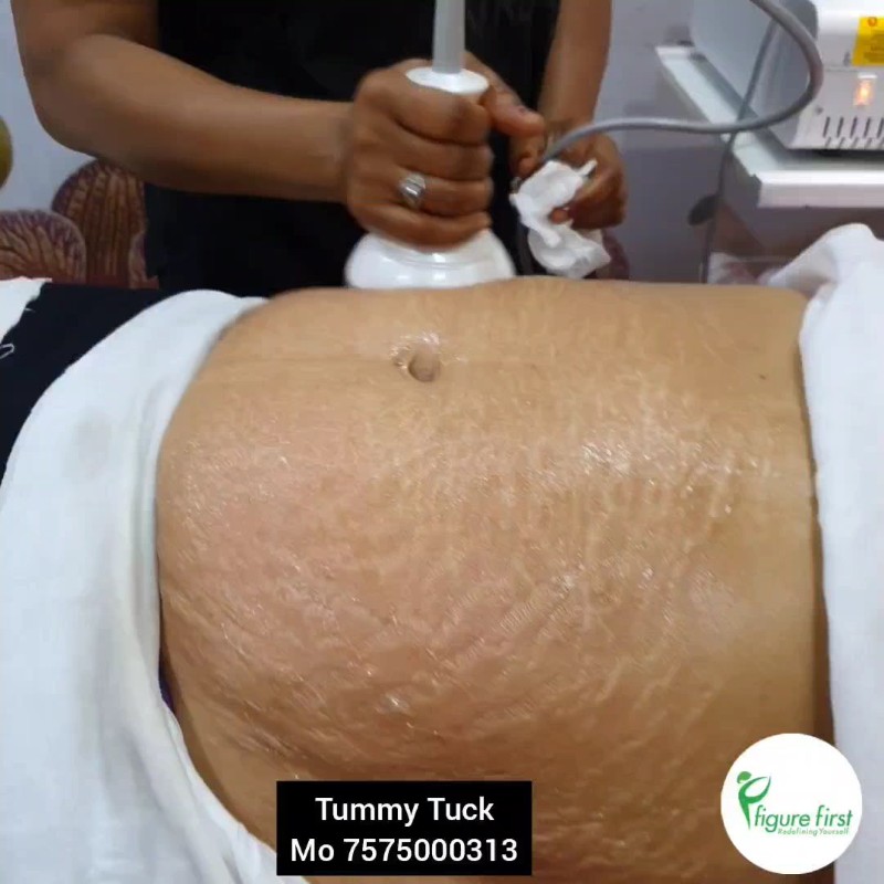 Non-Surgical Tummy Tuck & Body Tightening Session